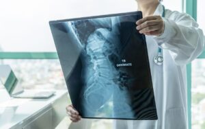 Understanding Herniated Disc C4/C5 and C5/C6...