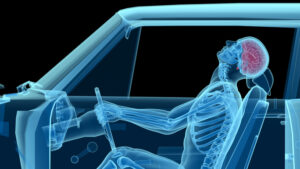 Traumatic Brain Injuries After a Car...