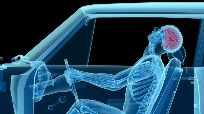 Traumatic Brain Injuries After a Car...